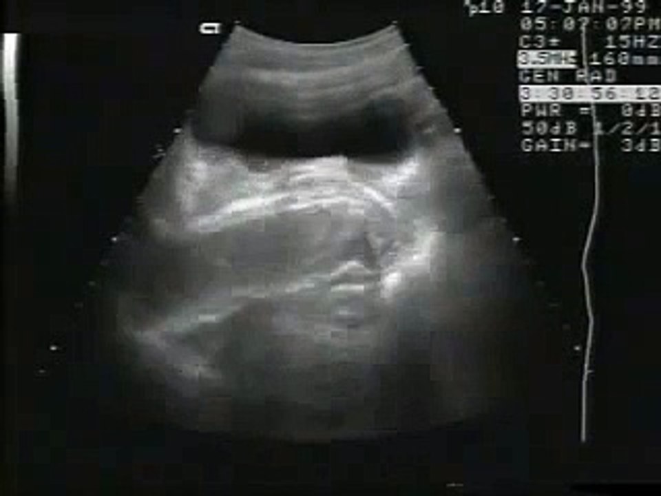 coitus by Ultrasonography