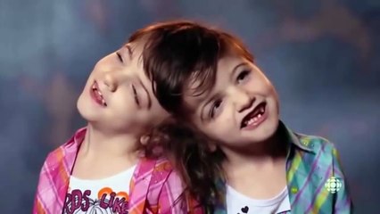 Girls conjoined at the head have brains that are interconnected