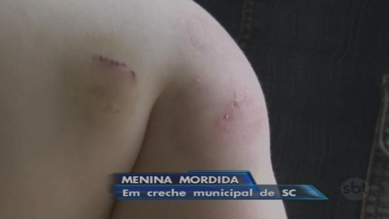 Criança é mordida diversas vezes em creche municipal de Xanxerê
