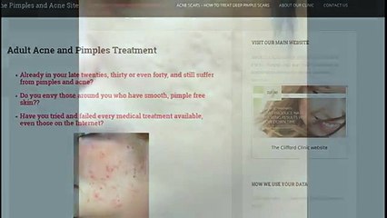 Permanent Treatment of Acne - Solution for Acne