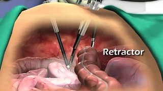 EndoGrab of Virtual Ports (laparoscopic procedures),produced by Virtual Point