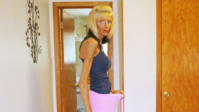 The Woman Who Can't Eat: Rare Medical Condition Causes Involuntary Starvation