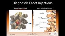 Radiofrequency Ablation (Radiofrequency Neurotomy) for Low Back Pain from Facet Joint Syndrome