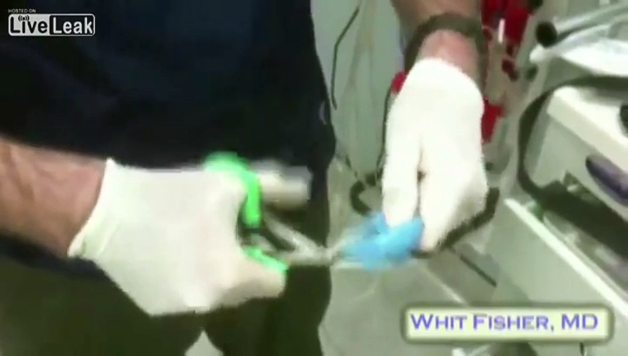 Foreign Objects Found In peoples Rectum, with a demonstration how to remove large ones.