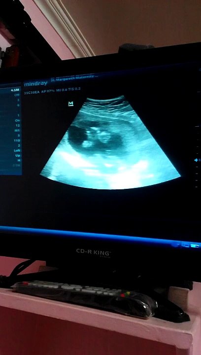 Ultrasound ni baby