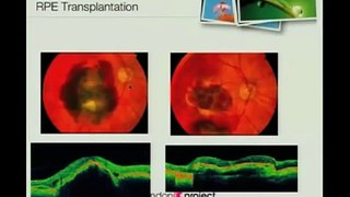 Frenar la pérdida de visión con células madre - Parte 2 de 3