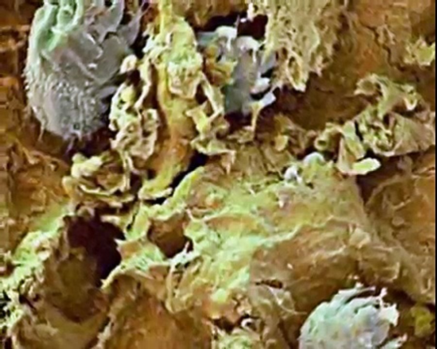 Demodex Blepharitis - Is it for real?