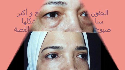 اسئلة هامة من الناس و اجابتها عن جراحات تجميل و اصلاح الجفون 3 د. هيام عادل