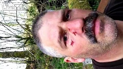 When Fishing Hooks your Face - Are you in Pain, Brother?