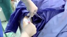 general anesthesia with endotracheal intubation