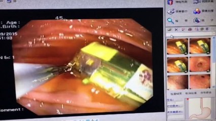 Man has lighter surgically removed after swallowing it
