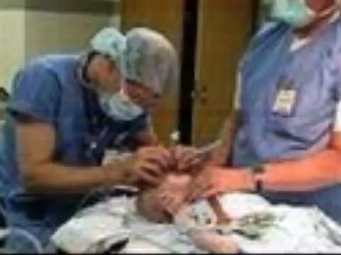 Fetal Alcohol SYndrome