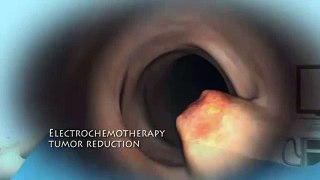 VSCHV Electrochemothearapy Tumor Reduction