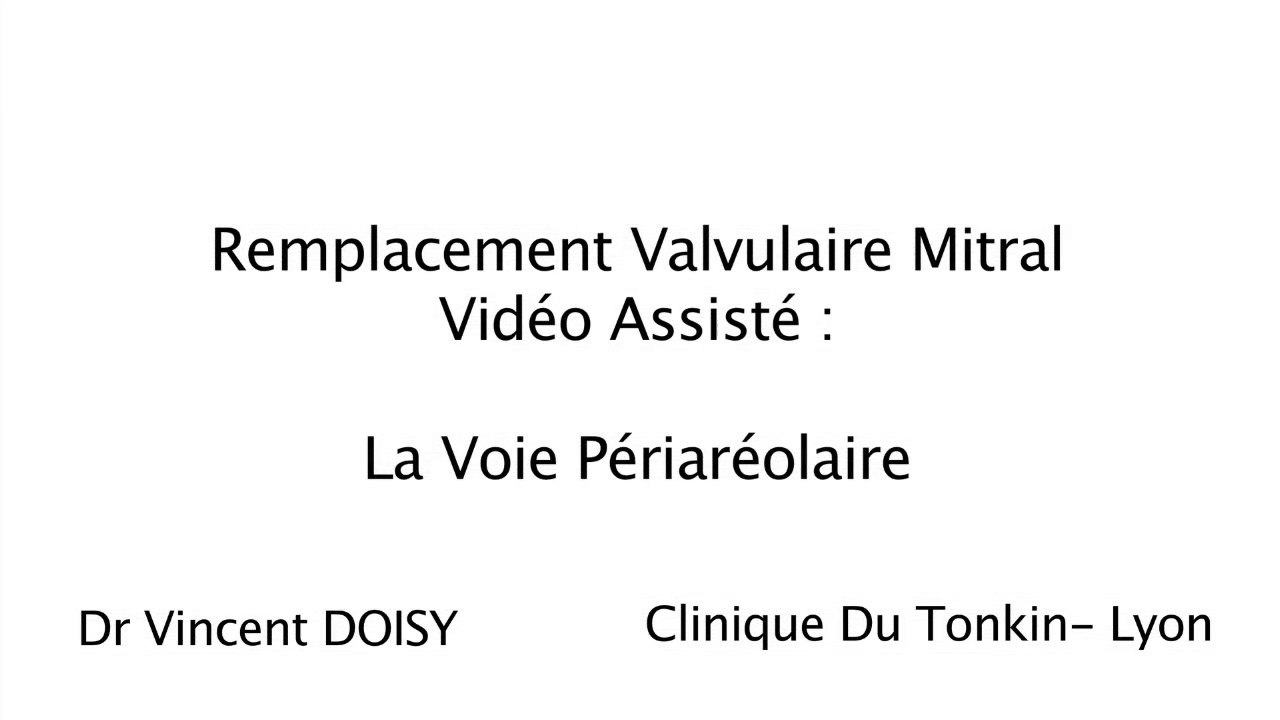 minimally invasive mitral surgery Dr Doisy