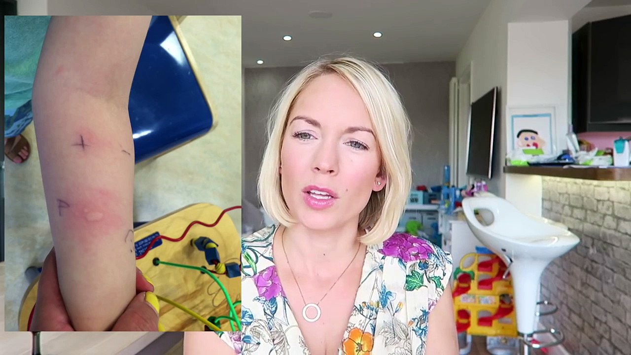 CHILD PEANUT ALLERGY | EMILY NORRIS