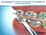 Soluciones a problemas frecuentes en Ortodoncia