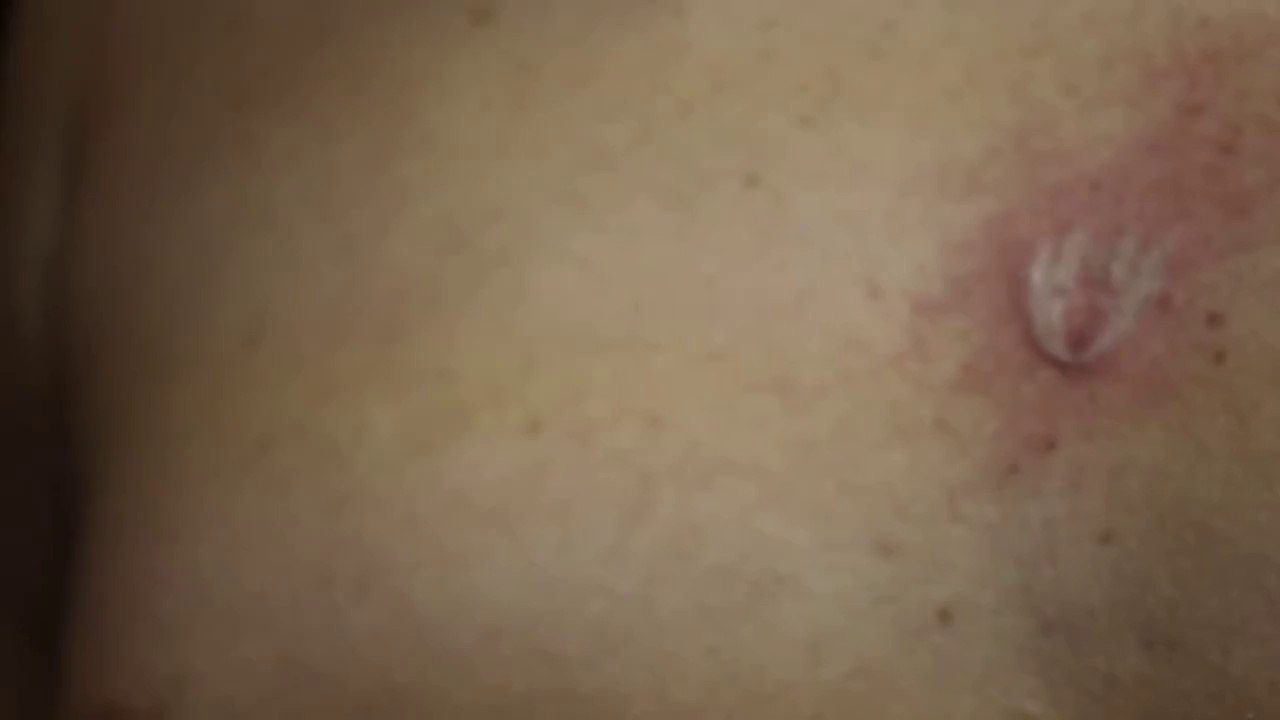 Burning a bottle cap into a nipple.