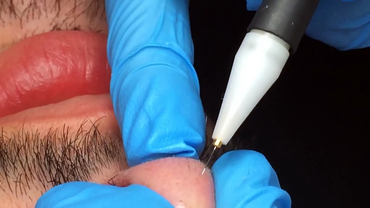 Electrolysis on the Nose Tip