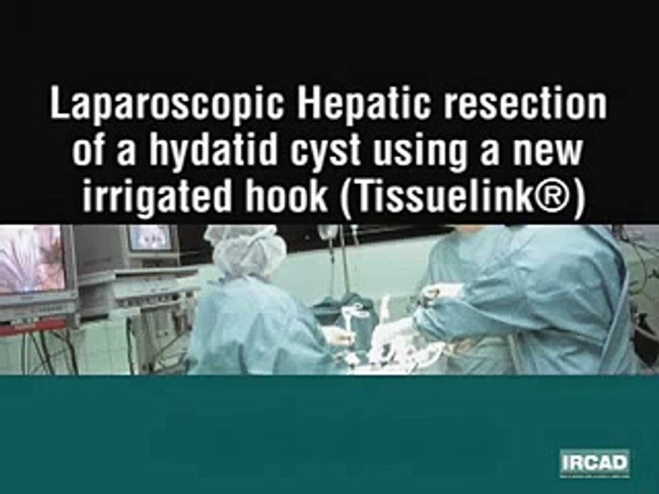 laparoscopic hepatic resection of a hydatid cyst