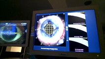 Surgeon POV Small Pupil Laser Cataract Surgery