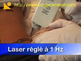 Seance de detatouage, tattoo removal treatment laser