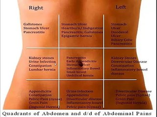 Differential diagnosis of abdominal pain according to abdominal regions
