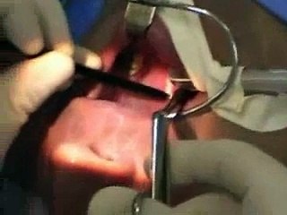 Cirurgia de amigdalas com bisturi ultrassônico (ultracision)