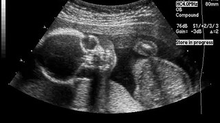 20 Week ultrasound