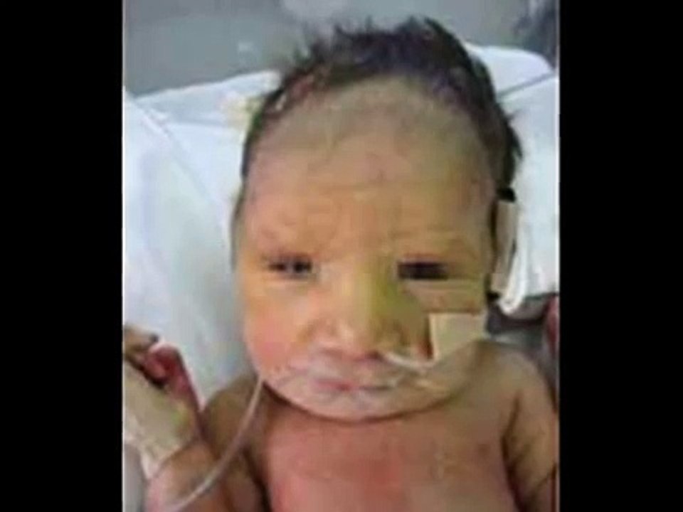 Sindrome de Patau