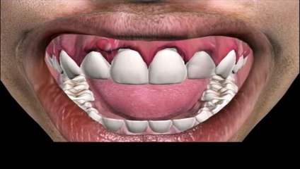 Tooth Abscess Relief