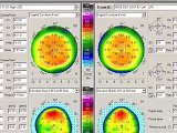 Hyperopia Topography-guided treatment compared to standard