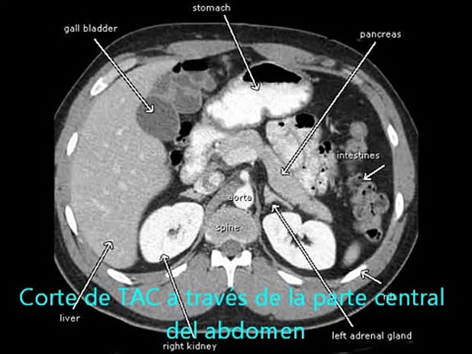 TAC de Abdomen