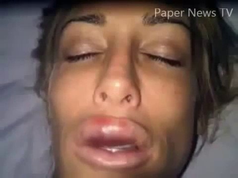 Plastic surgery gone wrong: Korean model disfigured after cooking oil injections