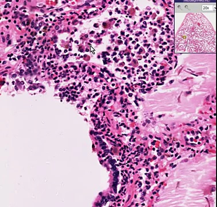 Histopathology Lung--Early pneumonia