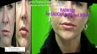 Los Angeles Radiesse- Treating Laugh lines & Droopiness In Lower Face