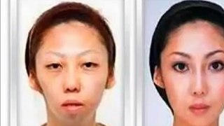 Cirugias esteticas coreanas ANTES Y DESPUES