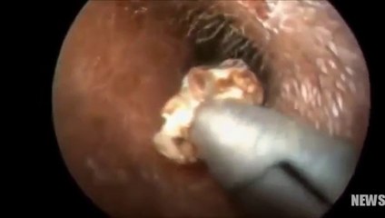 Extraen 26 cucarachas vivas del oído de un joven