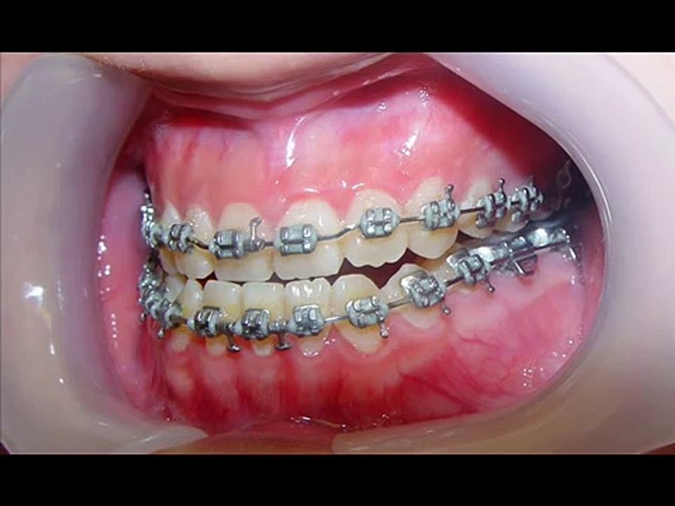 Jaw Surgery