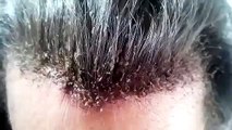 Oh No: Dude Has A Major Hair Lice Infestation! [Full Episode]