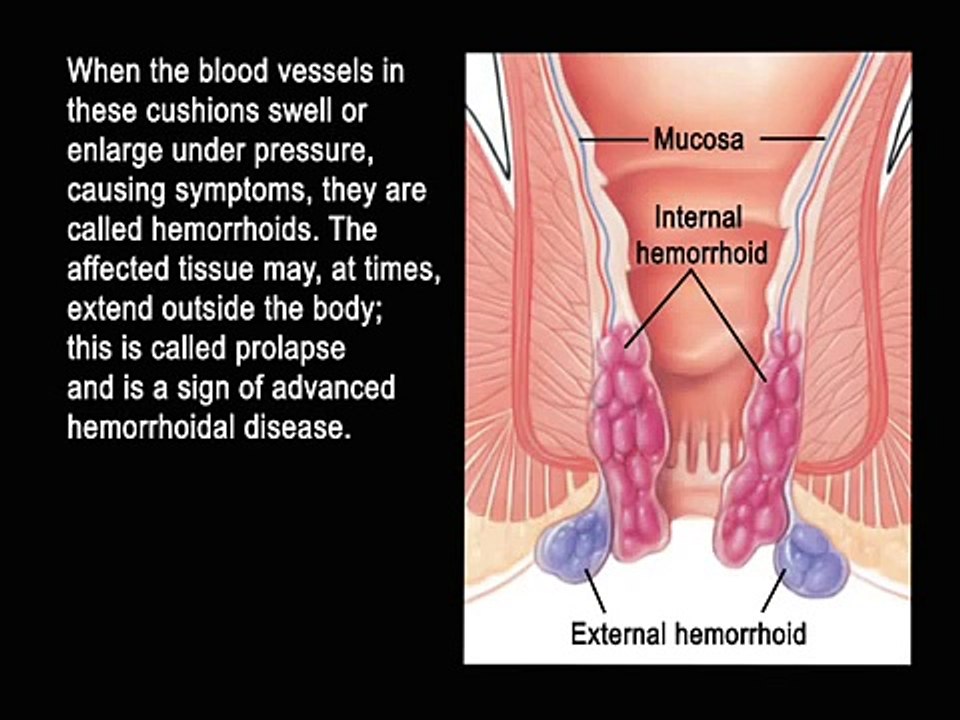 procedure for prolapsing hemorrhoids
