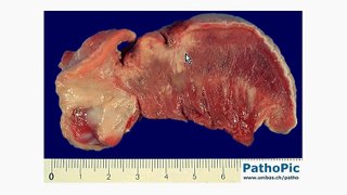 Histopathology Tongue -- Squamous cell carcinoma