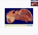 Histopathology Tongue -- Squamous cell carcinoma