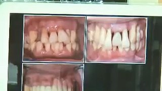 何謂牙周病