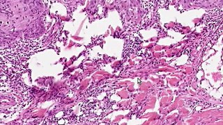 Histopathology Skin-- Squamous cell carcinoma