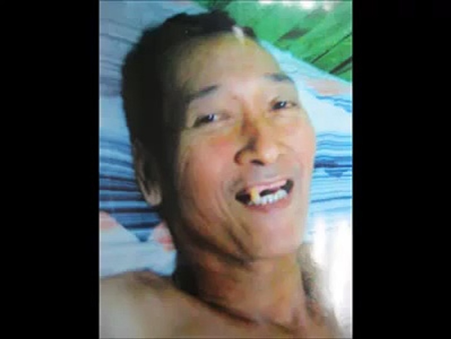 BONE CANCER SURVIVOR WITHOUT CHEMOTHERAPY