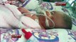 Mom Gives Birth To Conjoined Twins, 