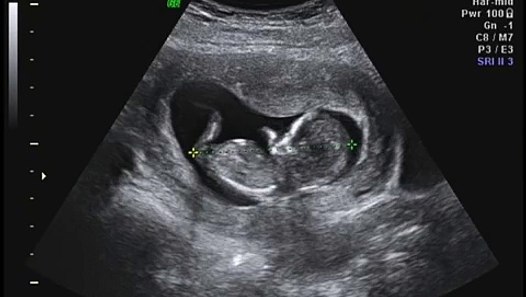 12 weeks 1 day Ultrasound - video dailymotion