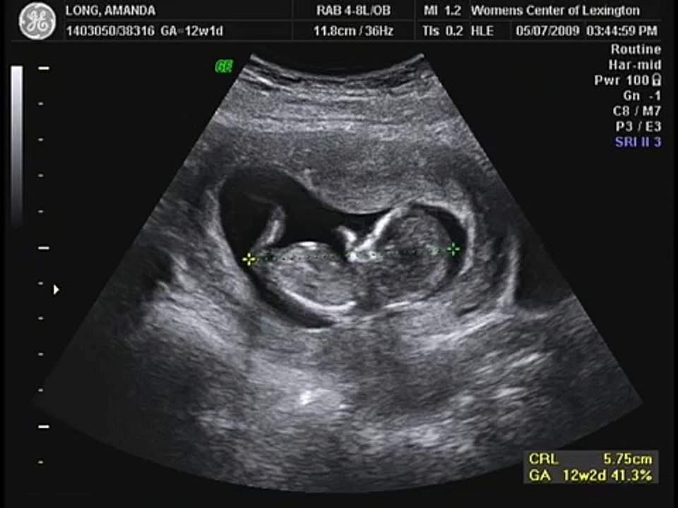 12 weeks 1 day Ultrasound