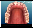 Invisalign- how does it work, Invisalign dentist Sydney 0296591200