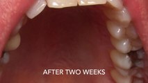 Treatment of Gum Recession upper canine with Connective Tissue Graft.
